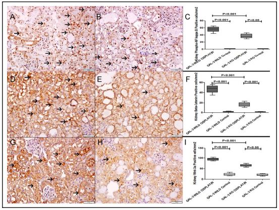 Fig. 12. A. Representative section from kidneys of cisplatin-treated GAL-3 wild mice immunohistochemically stained with p-NF kappa B showing acute tubular necrosis with many tubular cells showing nuclear  expression of p-NF kappa B (arrow).